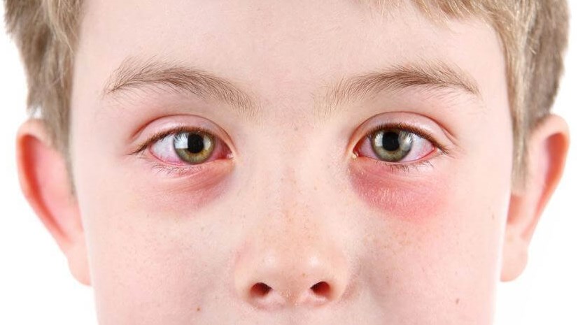 Pink Eye